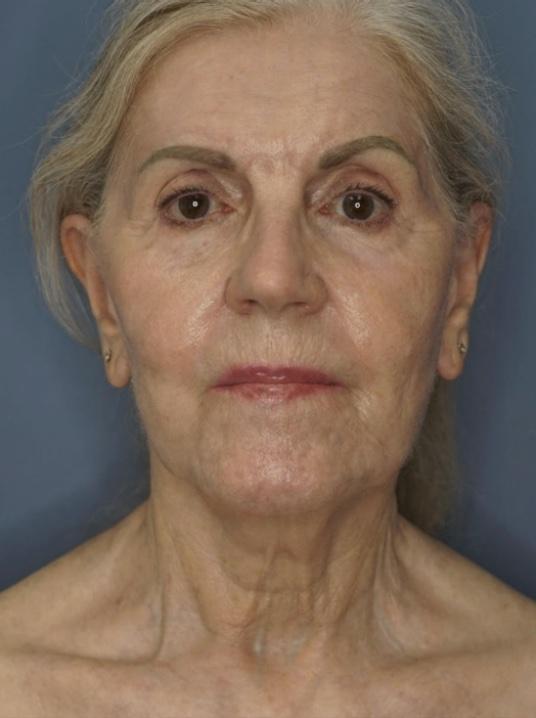 Facelift before at Dr. Petti in Los Angeles, CA