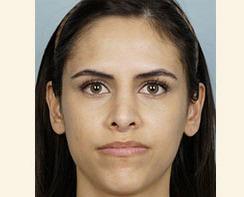 Rhinoplasty after at Dr. Petti in Los Angeles, CA