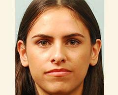 Rhinoplasty before at Dr. Petti in Los Angeles, CA