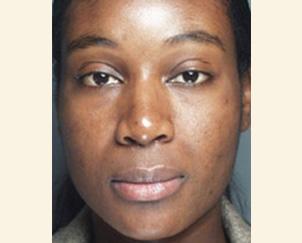 Dr. Petti rhinoplasty after — Los Angeles, CA