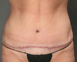 Tummy Tuck after at Dr. Petti in Los Angeles, CA