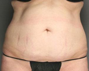 Tummy Tuck before at Dr. Petti in Los Angeles, CA
