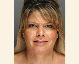 Dr. Petti rhinoplasty after — Los Angeles, CA