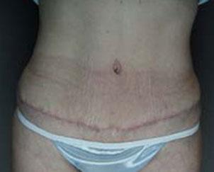 Tummy Tuck after at Dr. Petti in Los Angeles, CA