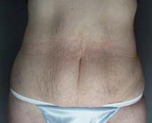 Tummy Tuck before at Dr. Petti in Los Angeles, CA