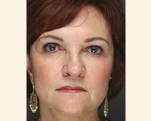 Brow Lift after at Dr. Petti in Los Angeles, CA