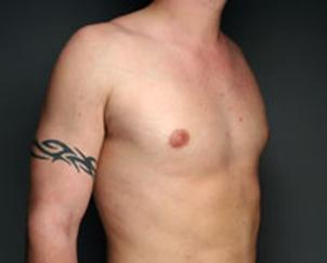 Gynecomastia Surgery after at Dr. Petti in Los Angeles, CA