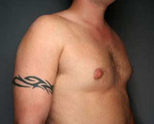 Gynecomastia Surgery before at Dr. Petti in Los Angeles, CA
