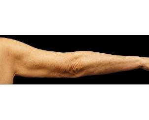 Dr. Petti liposuction after — Los Angeles, CA