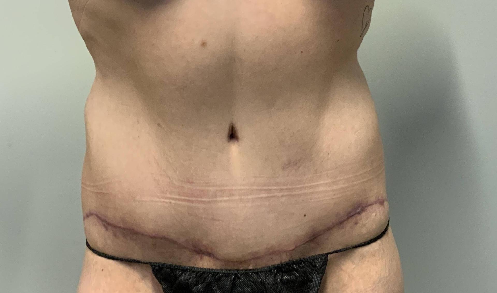 The Waldorf Center for Plastic Surgery tummy tuck after — Portland, OR