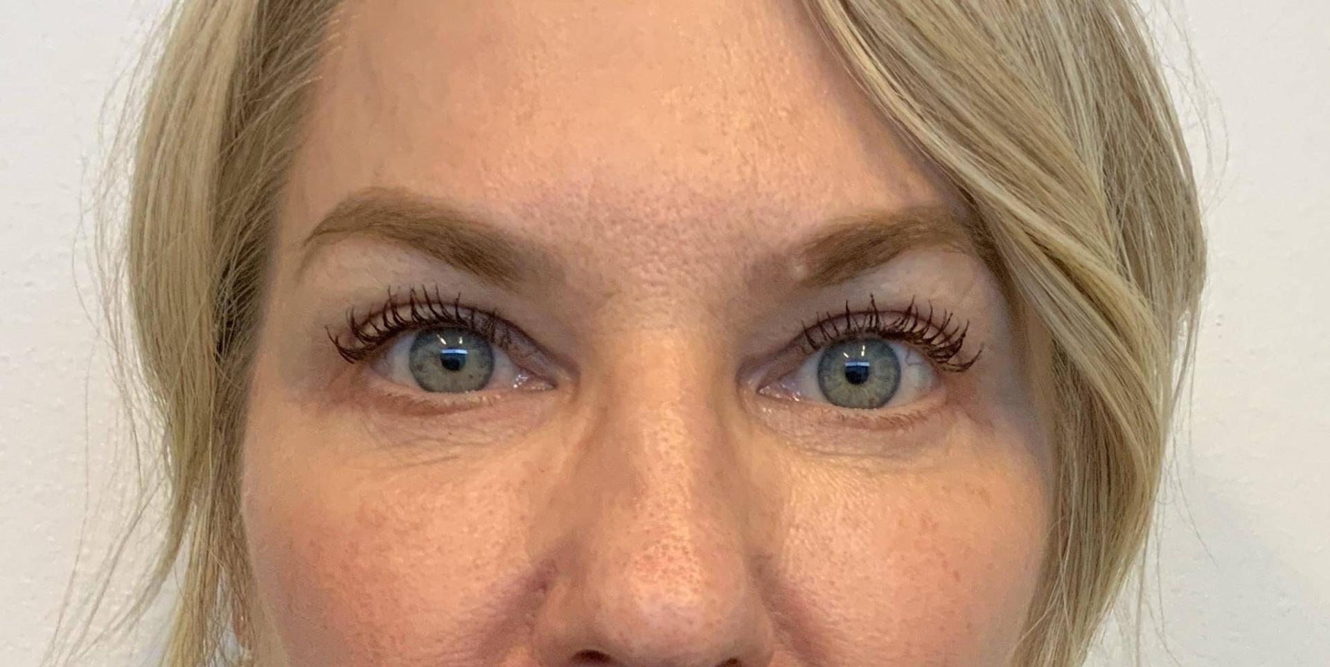 The Waldorf Center for Plastic Surgery eyelid lift after — Portland, OR