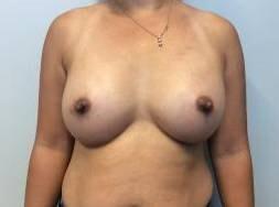 Breast Augmentation after at The Waldorf Center for Plastic Surgery in Portland, OR