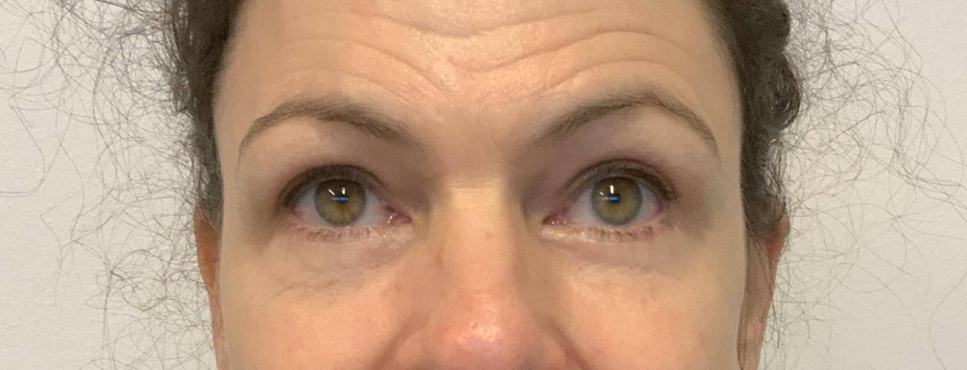 The Waldorf Center for Plastic Surgery eyelid lift after — Portland, OR