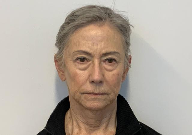 Neck Lift before at The Waldorf Center for Plastic Surgery in Portland, OR
