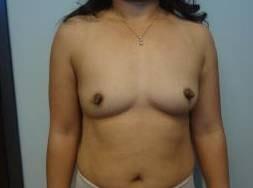 Breast Augmentation before at The Waldorf Center for Plastic Surgery in Portland, OR