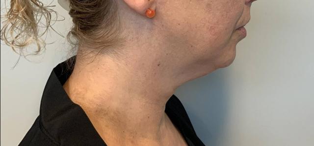 Neck Lift before at The Waldorf Center for Plastic Surgery in Portland, OR