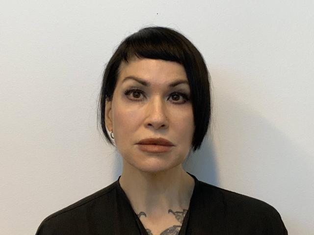 Neck Lift after at The Waldorf Center for Plastic Surgery in Portland, OR