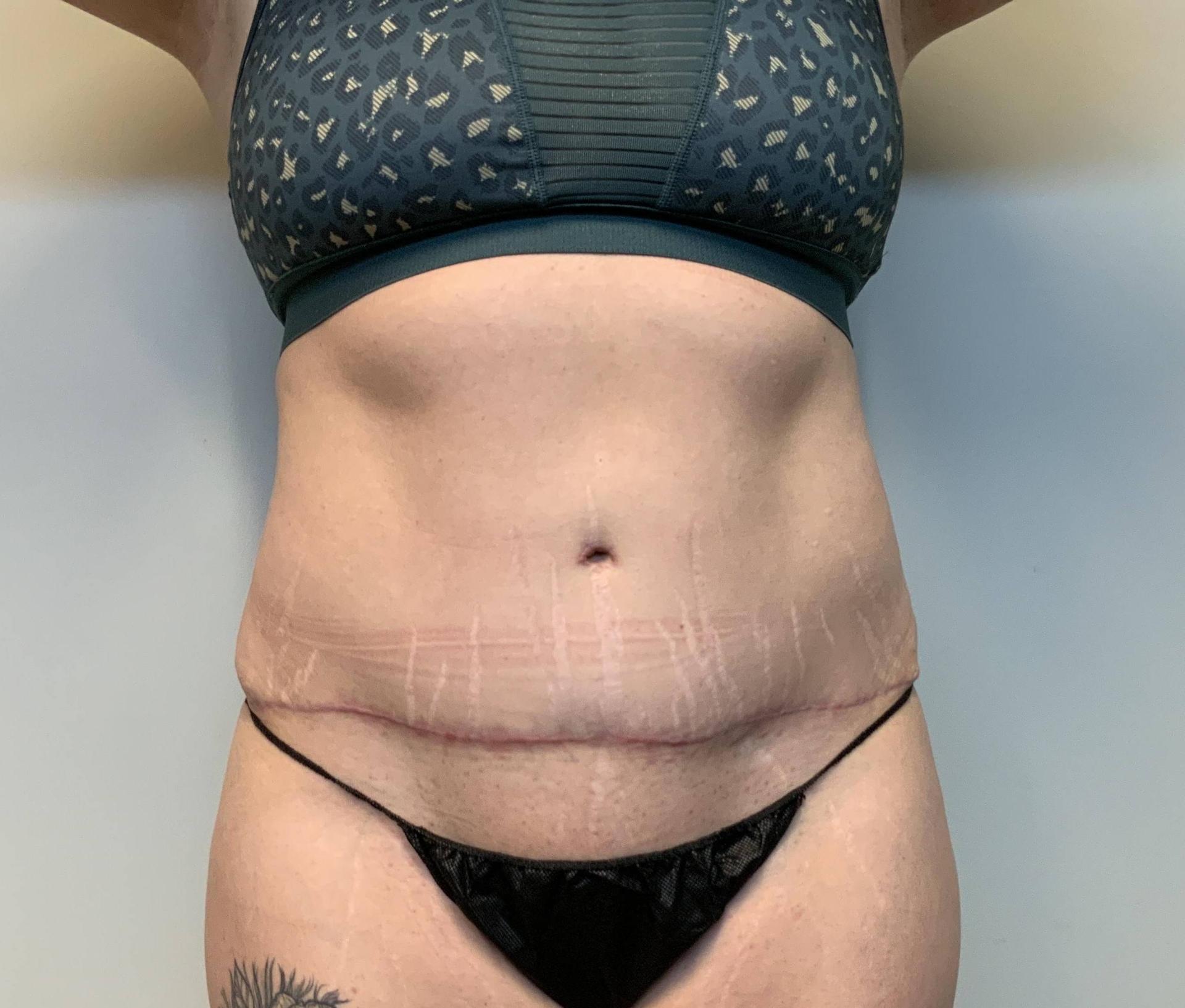 The Waldorf Center for Plastic Surgery tummy tuck after — Portland, OR
