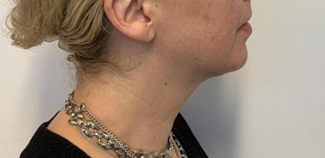 Neck Lift after at The Waldorf Center for Plastic Surgery in Portland, OR