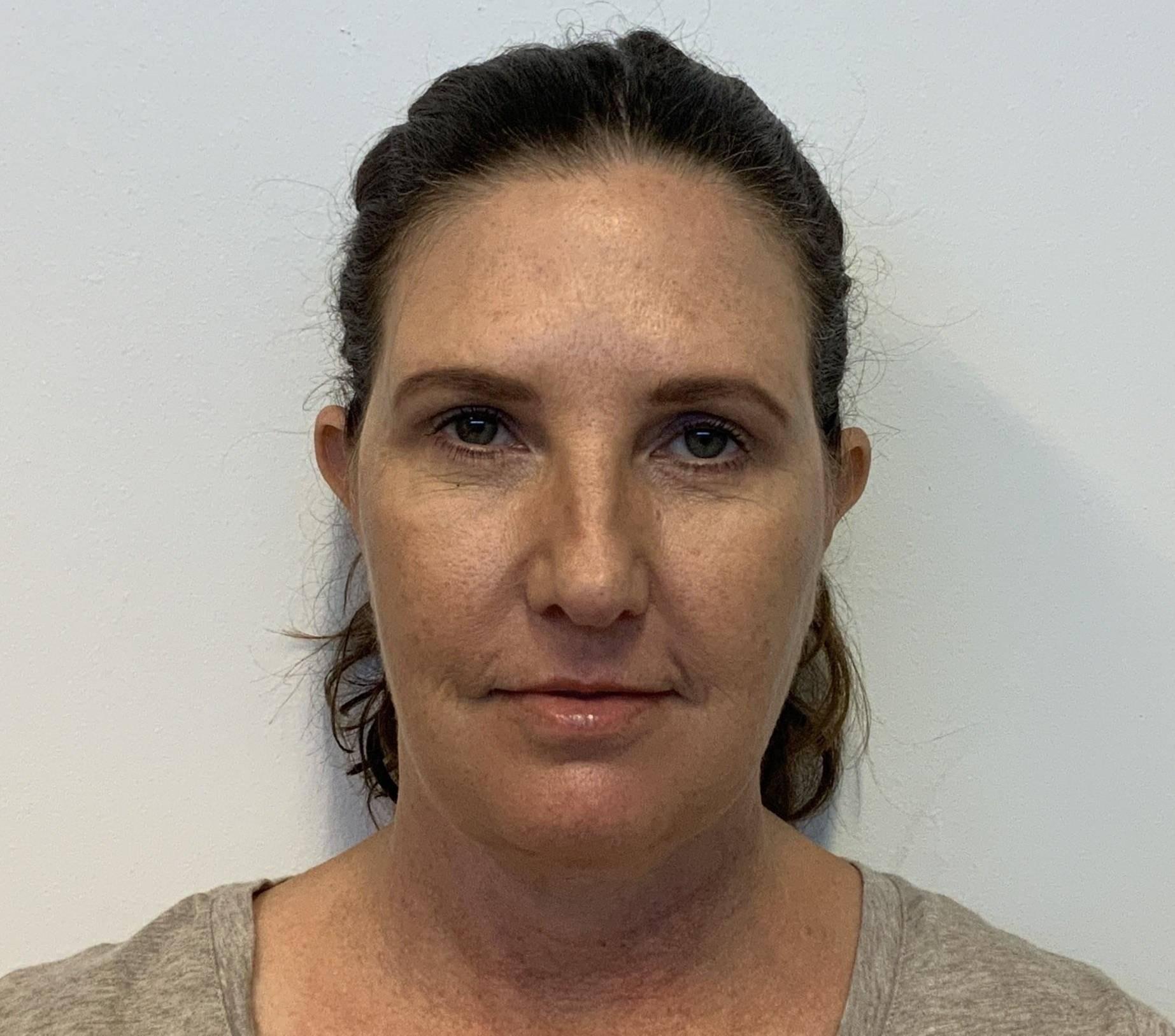 The Waldorf Center for Plastic Surgery eyelid lift after — Portland, OR