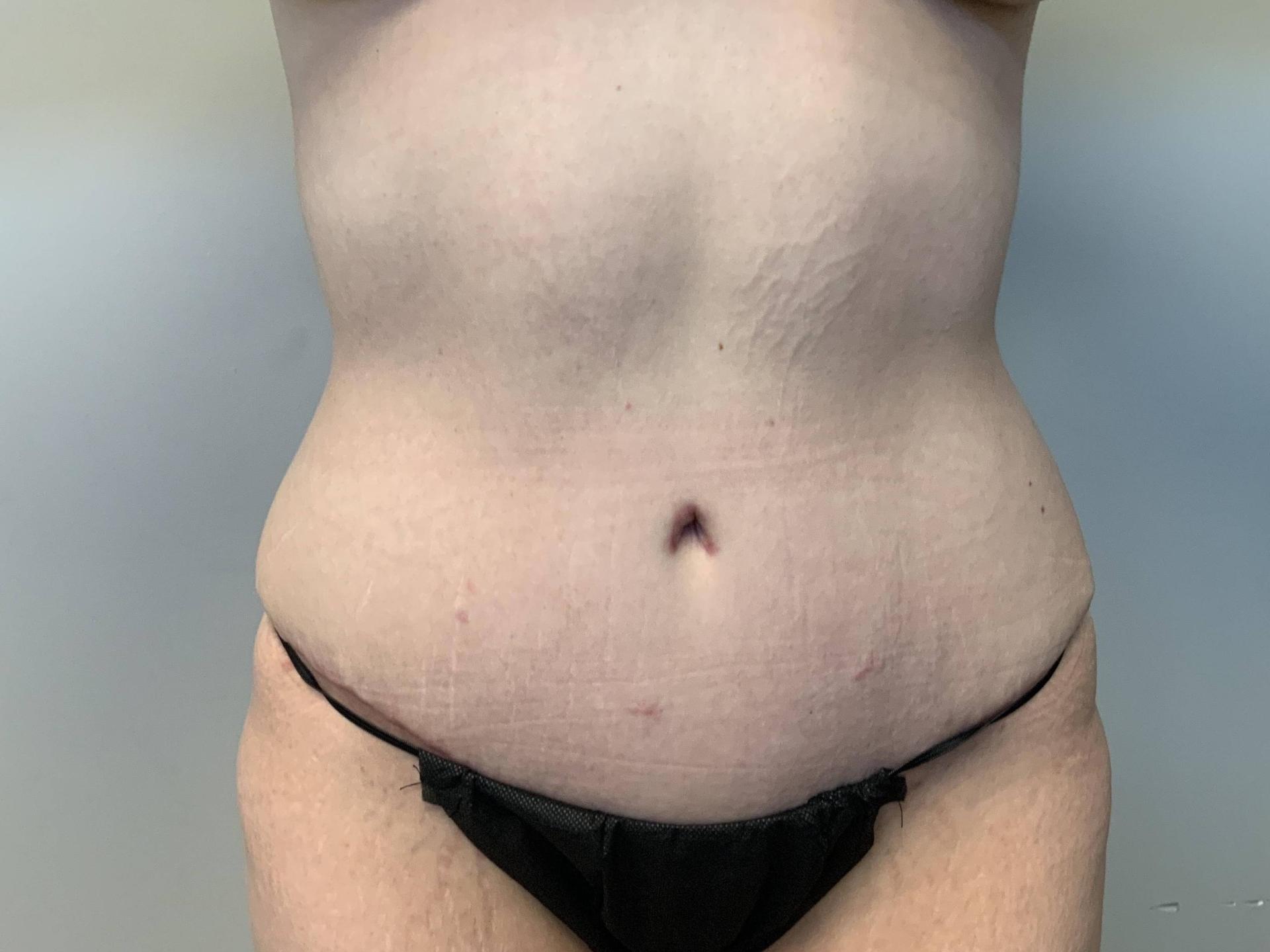 The Waldorf Center for Plastic Surgery tummy tuck after — Portland, OR