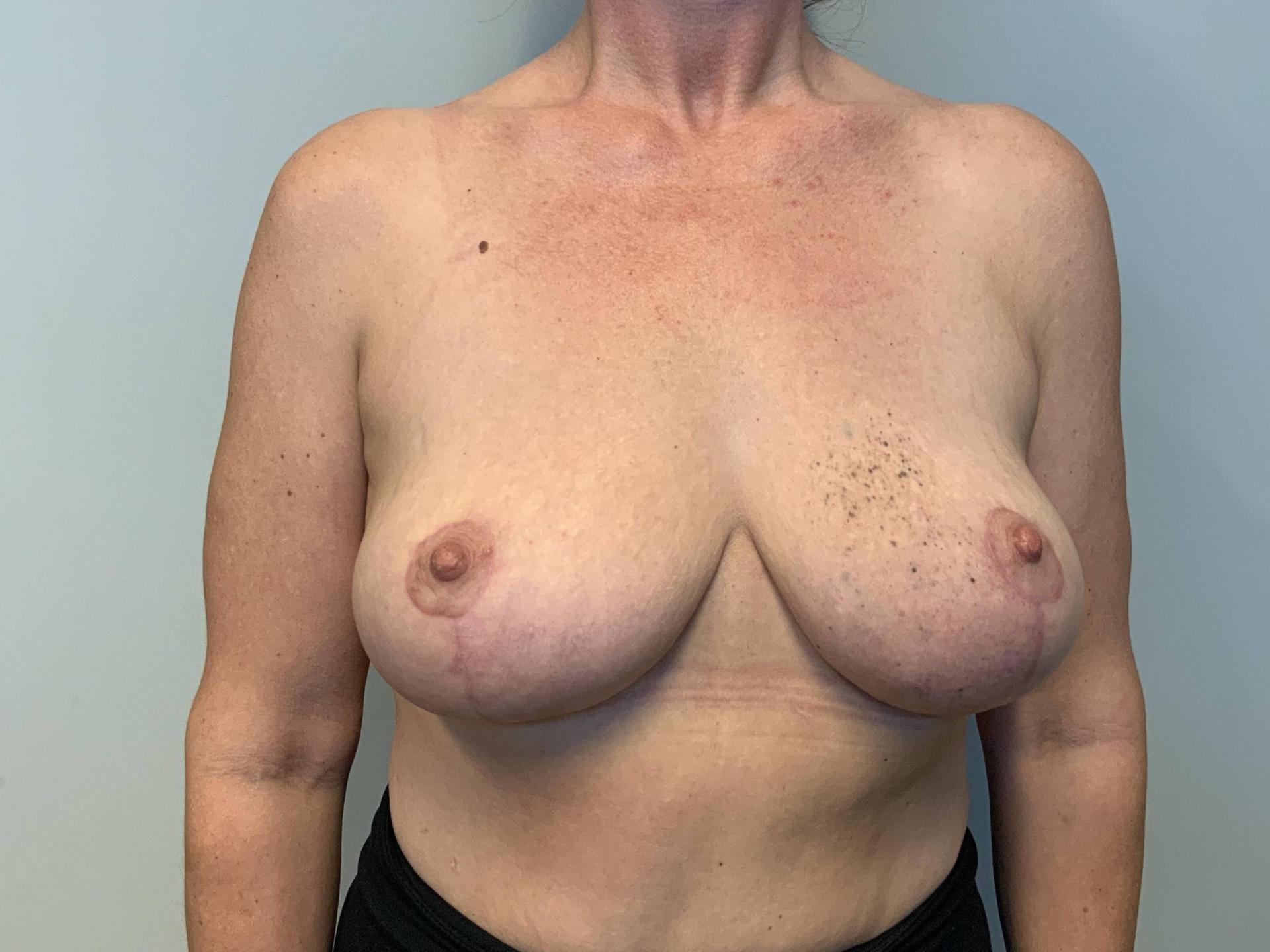 The Waldorf Center for Plastic Surgery breast lift after — Portland, OR