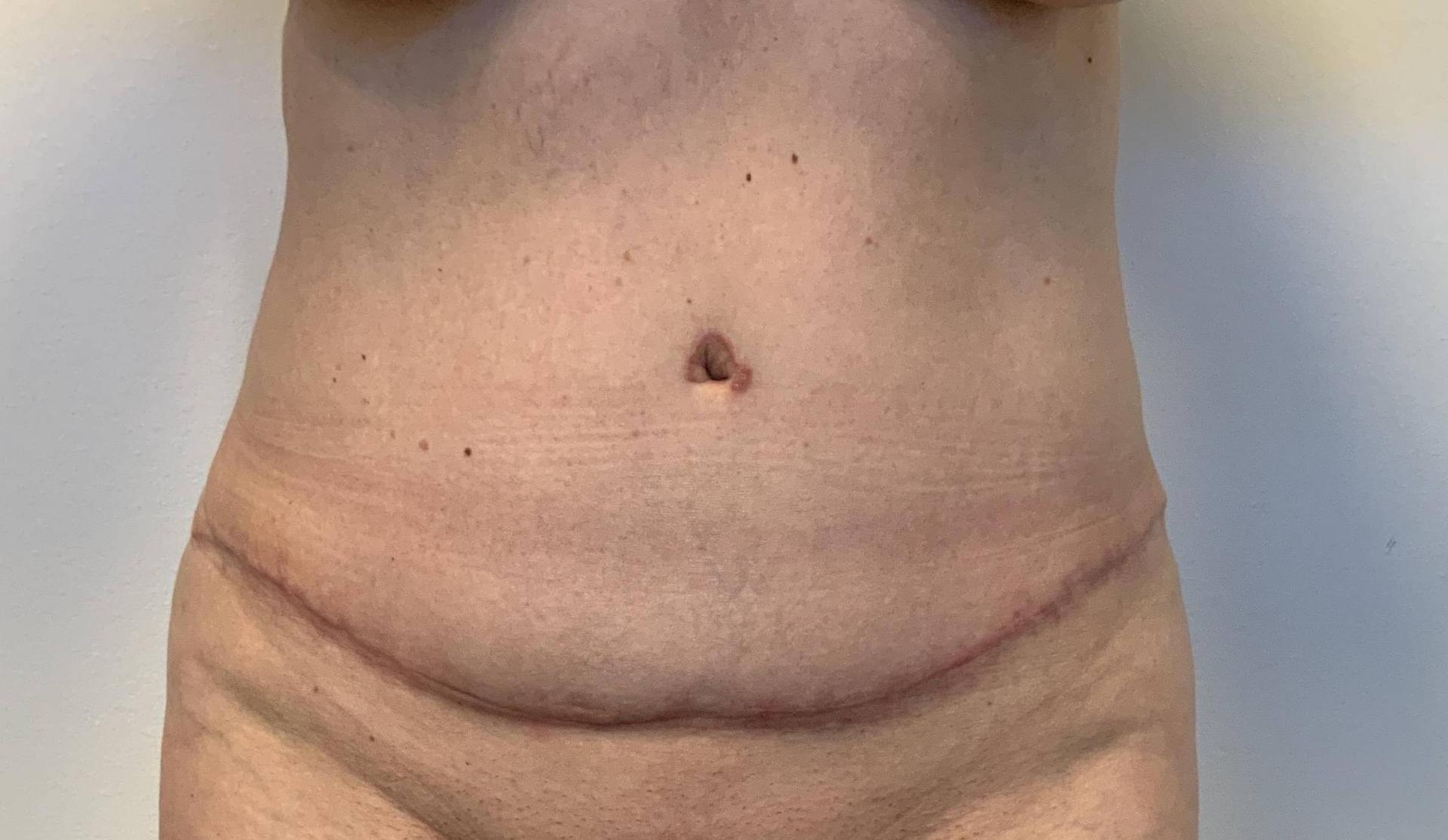 The Waldorf Center for Plastic Surgery tummy tuck after — Portland, OR