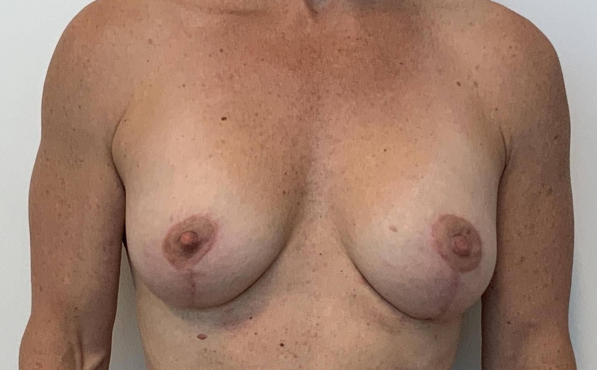 The Waldorf Center for Plastic Surgery breast lift after — Portland, OR