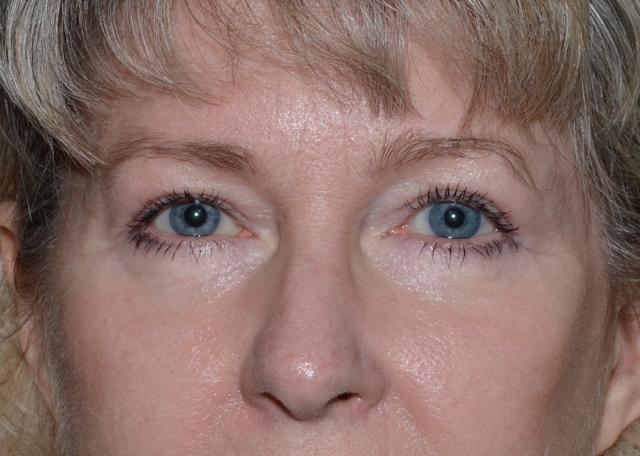 Blepharoplasty after at Amadi Aesthetics Plastic Surgery in Mercer Island, WA