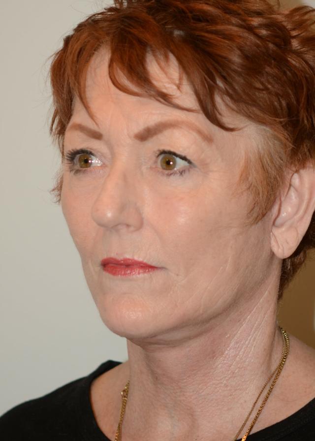 Deep Plane Facelift after at Amadi Aesthetics Plastic Surgery in Mercer Island, WA