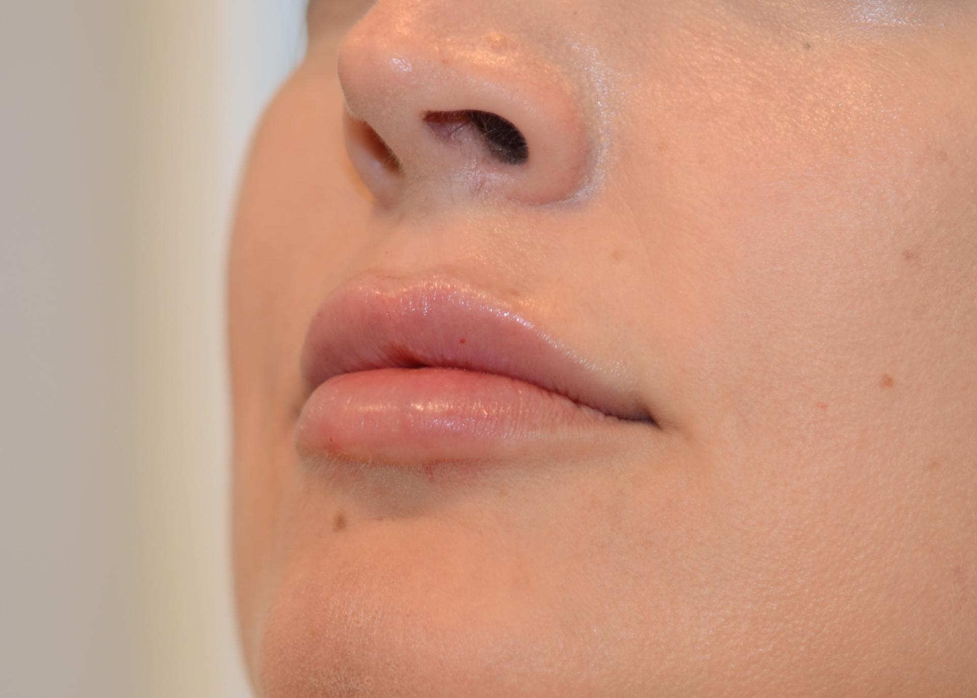 Amadi Aesthetics Plastic Surgery lip filler after — Mercer Island, WA