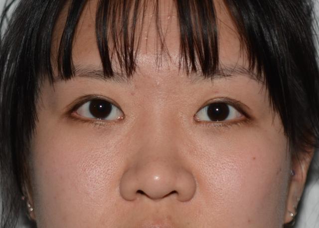 Blepharoplasty after at Amadi Aesthetics Plastic Surgery in Mercer Island, WA