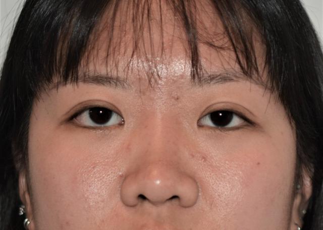 Blepharoplasty before at Amadi Aesthetics Plastic Surgery in Mercer Island, WA