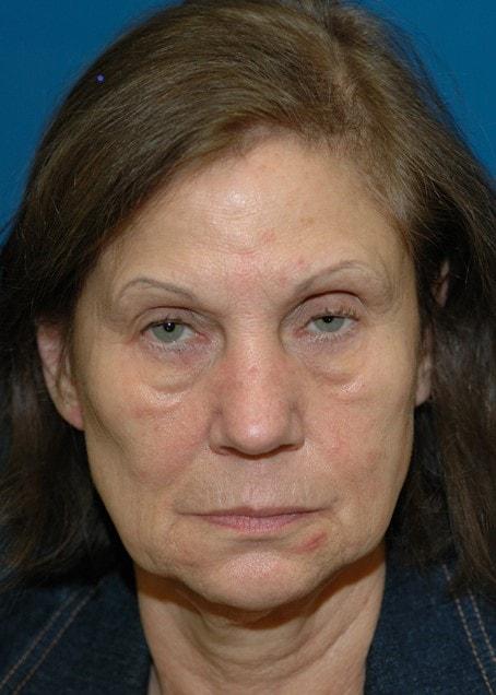 Fat Transfer before at Amadi Aesthetics Plastic Surgery in Mercer Island, WA