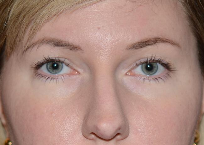 Amadi Aesthetics Plastic Surgery brow lift after — Mercer Island, WA