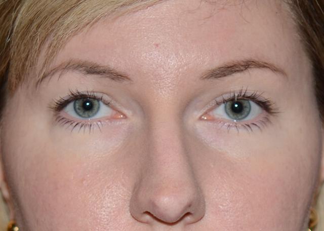 Brow Lift after at Amadi Aesthetics Plastic Surgery in Mercer Island, WA