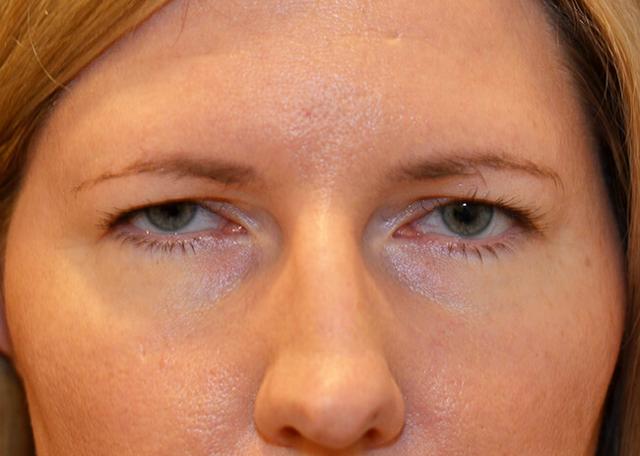 Brow Lift before at Amadi Aesthetics Plastic Surgery in Mercer Island, WA