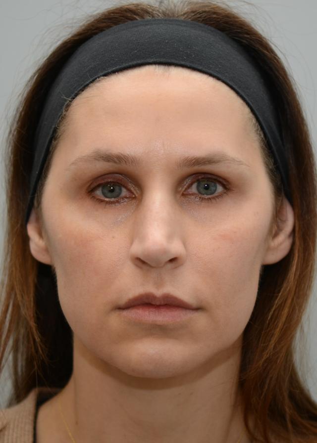 Fat Transfer before at Amadi Aesthetics Plastic Surgery in Mercer Island, WA