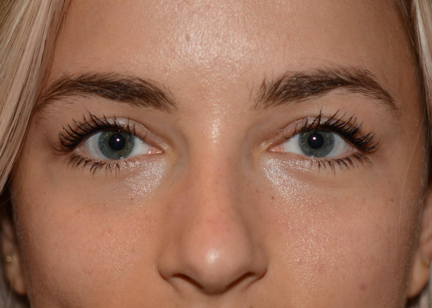 Amadi Aesthetics Plastic Surgery blepharoplasty after — Mercer Island, WA