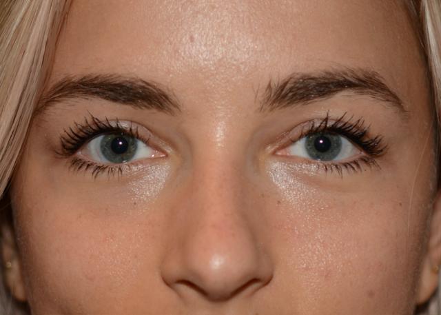 Blepharoplasty after at Amadi Aesthetics Plastic Surgery in Mercer Island, WA