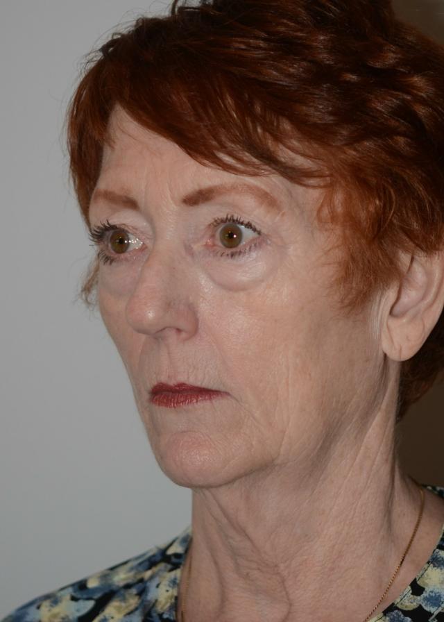 Deep Plane Facelift before at Amadi Aesthetics Plastic Surgery in Mercer Island, WA