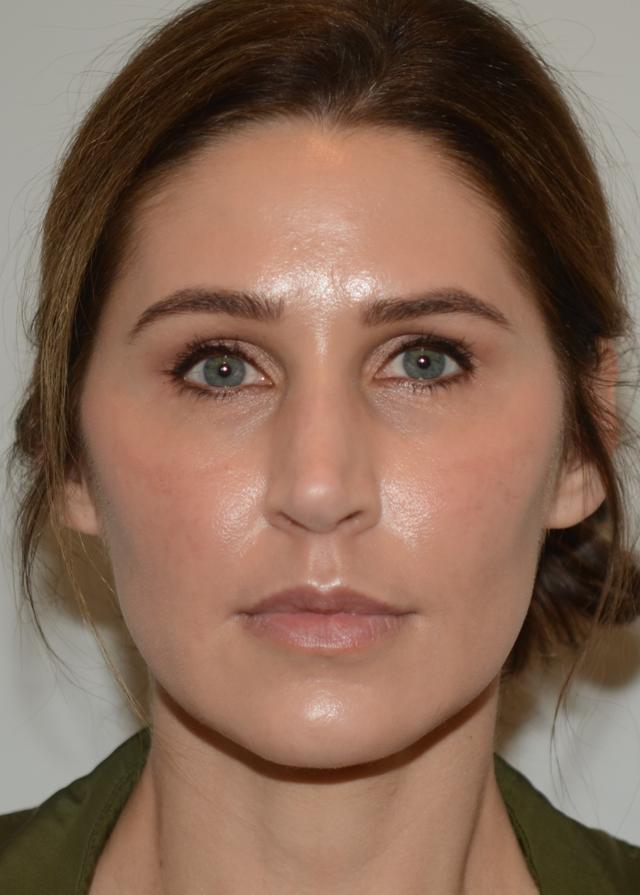 Fat Transfer after at Amadi Aesthetics Plastic Surgery in Mercer Island, WA