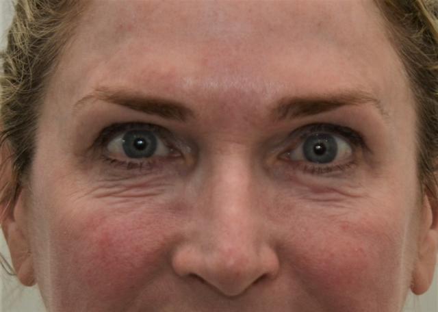 Laser Skin Resurfacing before at Amadi Aesthetics Plastic Surgery in Mercer Island, WA