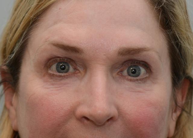 Laser Skin Resurfacing after at Amadi Aesthetics Plastic Surgery in Mercer Island, WA