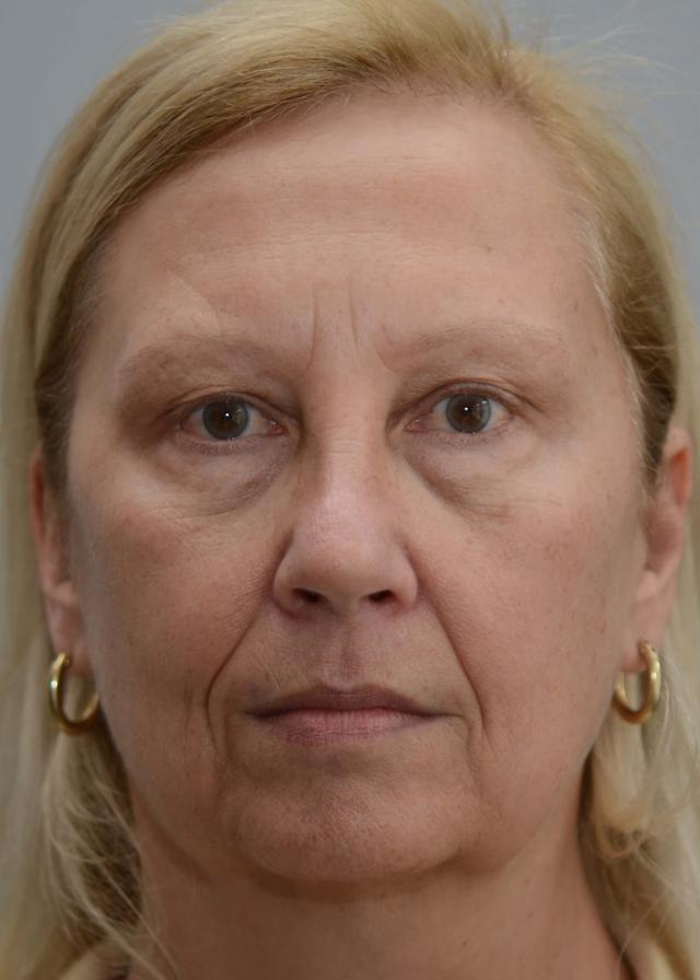 Laser Skin Resurfacing before at Amadi Aesthetics Plastic Surgery in Mercer Island, WA