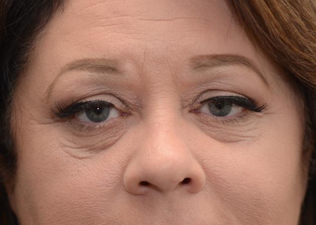 Blepharoplasty before at Amadi Aesthetics Plastic Surgery in Mercer Island, WA