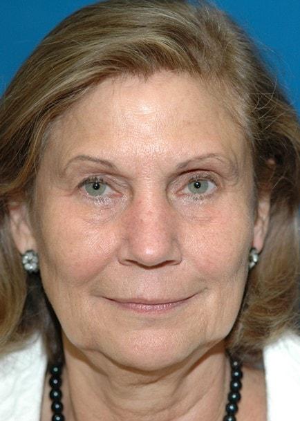 Fat Transfer after at Amadi Aesthetics Plastic Surgery in Mercer Island, WA