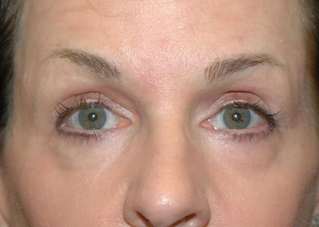 Laser Skin Resurfacing after at Amadi Aesthetics Plastic Surgery in Mercer Island, WA