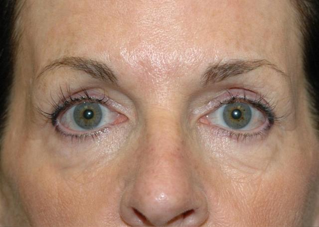 Laser Skin Resurfacing before at Amadi Aesthetics Plastic Surgery in Mercer Island, WA