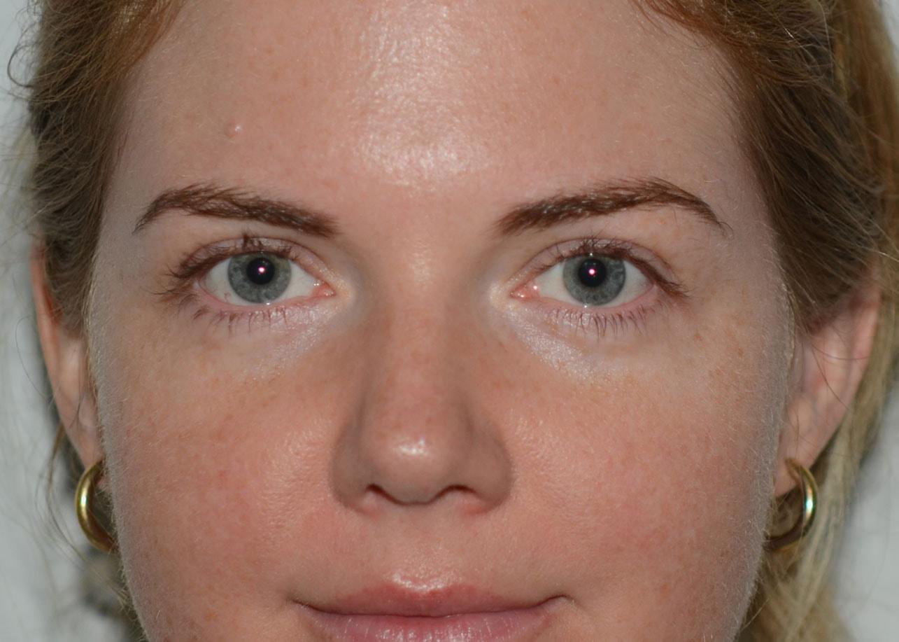Amadi Aesthetics Plastic Surgery eyelid lift after — Mercer Island, WA